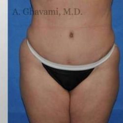 Abdominoplasty Before & After Patient #8144