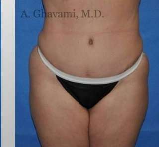 Abdominoplasty Before & After Patient #8144