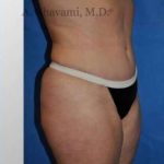 Abdominoplasty Before & After Patient #8144