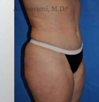 Abdominoplasty Before & After Patient #8144