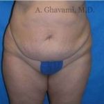 Abdominoplasty Before & After Patient #8144