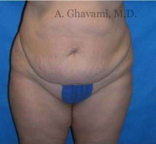 Abdominoplasty Before & After Patient #8144