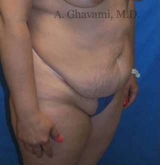Abdominoplasty Before & After Patient #8144