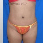 Abdominoplasty Before & After Patient #8139