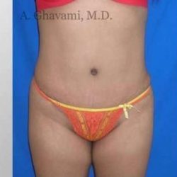 Abdominoplasty Before & After Patient #8139
