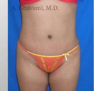 Abdominoplasty Before & After Patient #8139