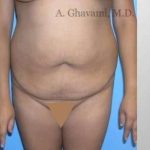 Abdominoplasty Before & After Patient #8139