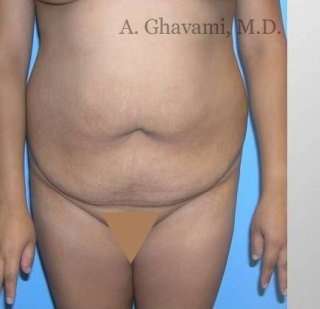 Abdominoplasty Before & After Patient #8139
