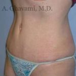 Abdominoplasty Before & After Patient #8136