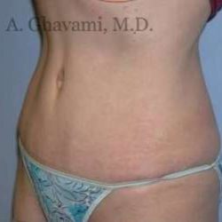 Abdominoplasty Before & After Patient #8136