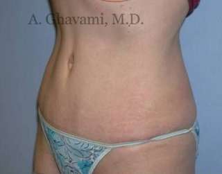 Abdominoplasty Before & After Patient #8136