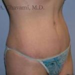 Abdominoplasty Before & After Patient #8136