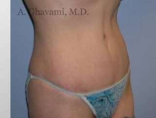 Abdominoplasty Before & After Patient #8136
