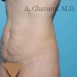 Abdominoplasty Before & After Patient #8136