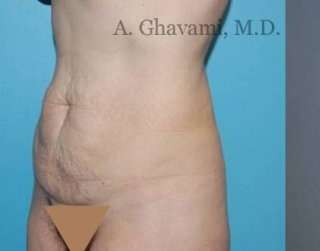 Abdominoplasty Before & After Patient #8136