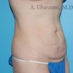 Abdominoplasty Before & After Patient #8136