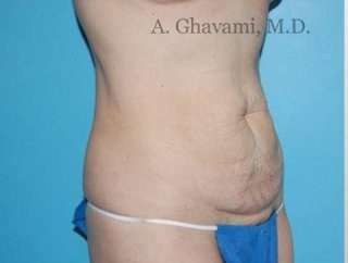 Abdominoplasty Before & After Patient #8136