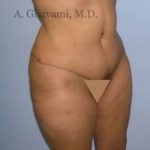 Abdominoplasty Before & After Patient #8131