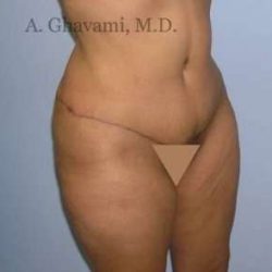 Abdominoplasty Before & After Patient #8131