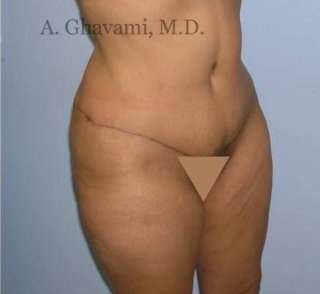 Abdominoplasty Before & After Patient #8131
