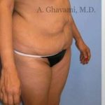 Abdominoplasty Before & After Patient #8131