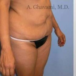 Abdominoplasty Before & After Patient #8131