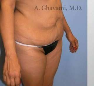 Abdominoplasty Before & After Patient #8131