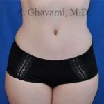 Abdominoplasty Before & After Patient #8128