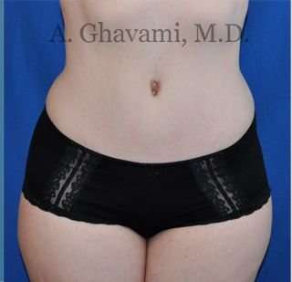 Abdominoplasty Before & After Patient #8128