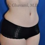 Abdominoplasty Before & After Patient #8128