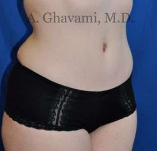 Abdominoplasty Before & After Patient #8128