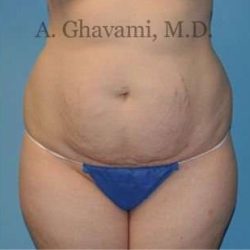 Abdominoplasty Before & After Patient #8128