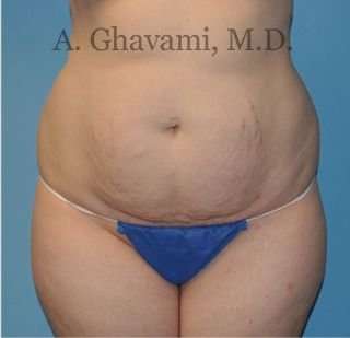 Abdominoplasty Before & After Patient #8128
