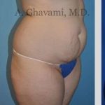 Abdominoplasty Before & After Patient #8128