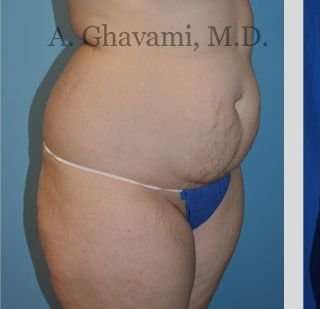 Abdominoplasty Before & After Patient #8128