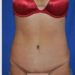 Abdominoplasty Before & After Patient #8123