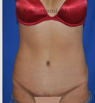 Abdominoplasty Before & After Patient #8123