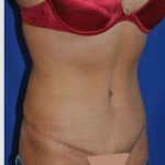 Abdominoplasty Before & After Patient #8123