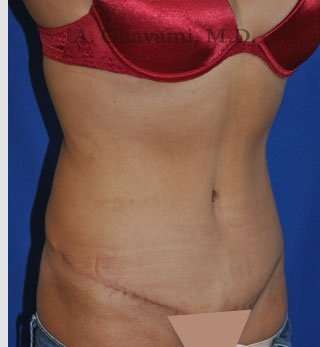 Abdominoplasty Before & After Patient #8123