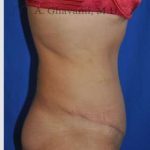 Abdominoplasty Before & After Patient #8123