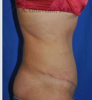 Abdominoplasty Before & After Patient #8123