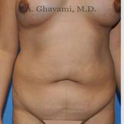 Abdominoplasty Before & After Patient #8123