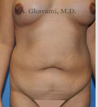 Abdominoplasty Before & After Patient #8123