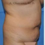 Abdominoplasty Before & After Patient #8123