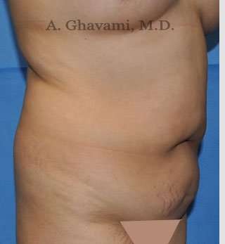Abdominoplasty Before & After Patient #8123