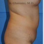 Abdominoplasty Before & After Patient #8123