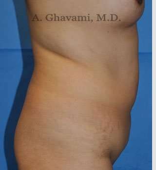 Abdominoplasty Before & After Patient #8123