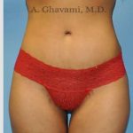 Abdominoplasty Before & After Patient #8116