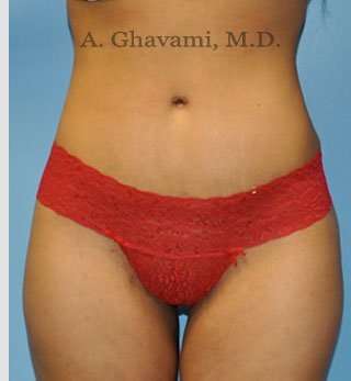 Abdominoplasty Before & After Patient #8116