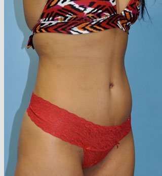 Abdominoplasty Before & After Patient #8116